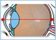 Осевая длина глаза