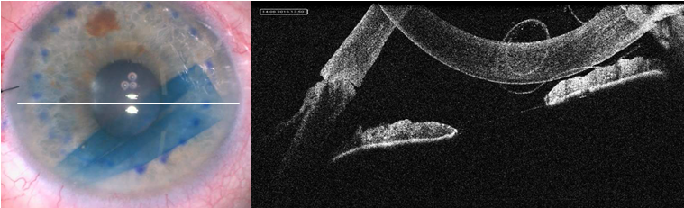 Снимок с камеры операционного микроскопа и с iOCT® камеры